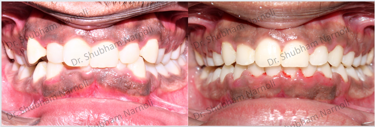 Before and after dental transformation 10