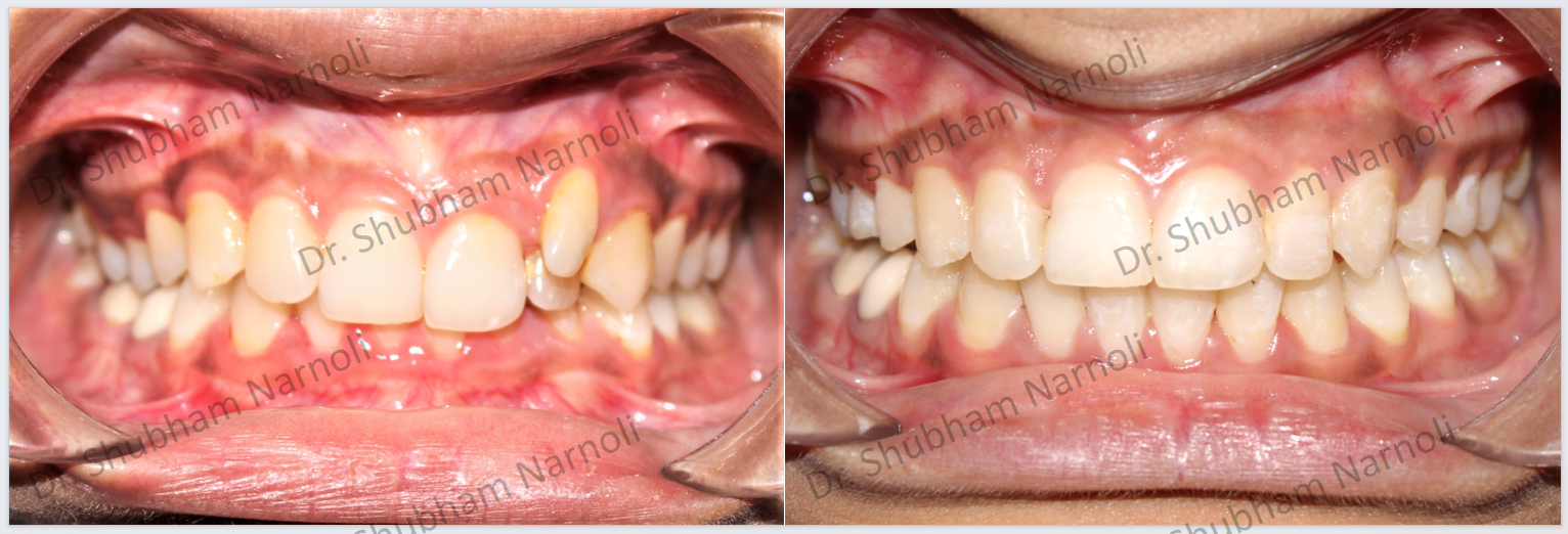 Before and after dental transformation 2