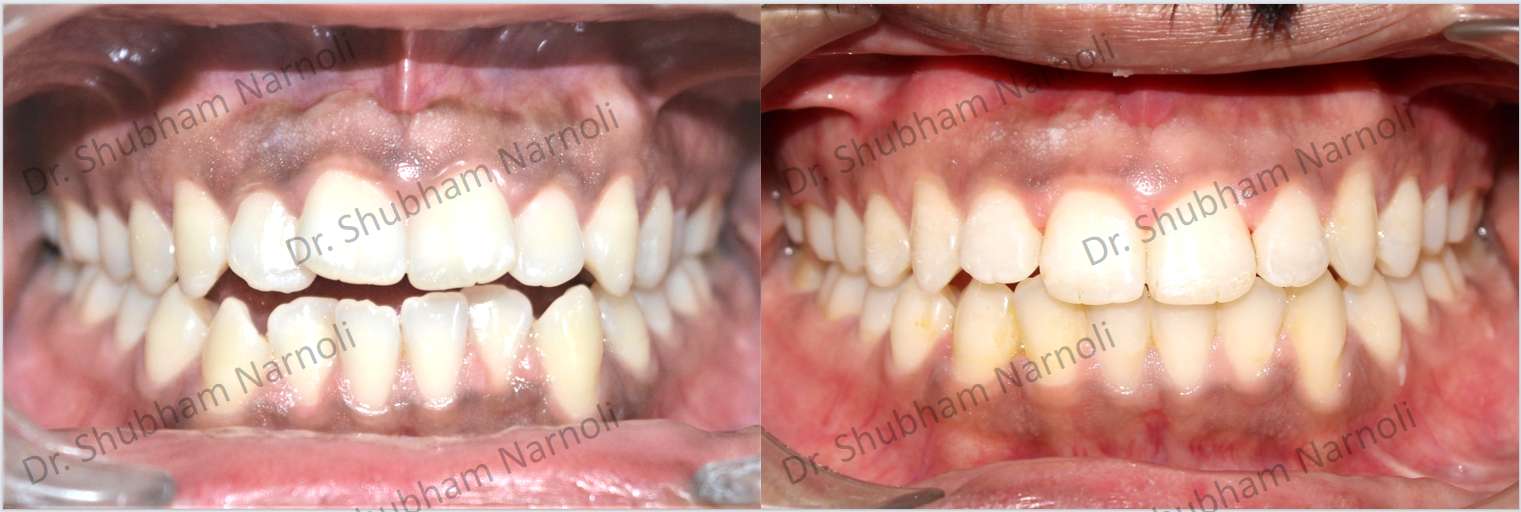 Before and after dental transformation 4