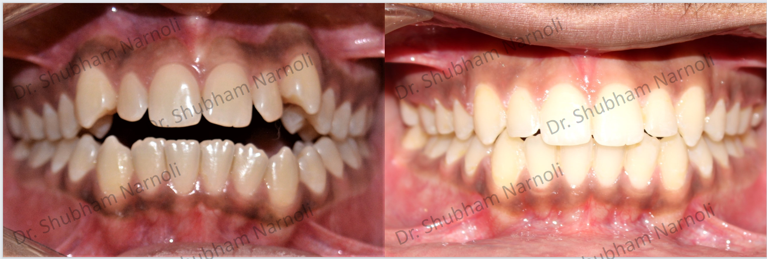 Before and after dental transformation 6