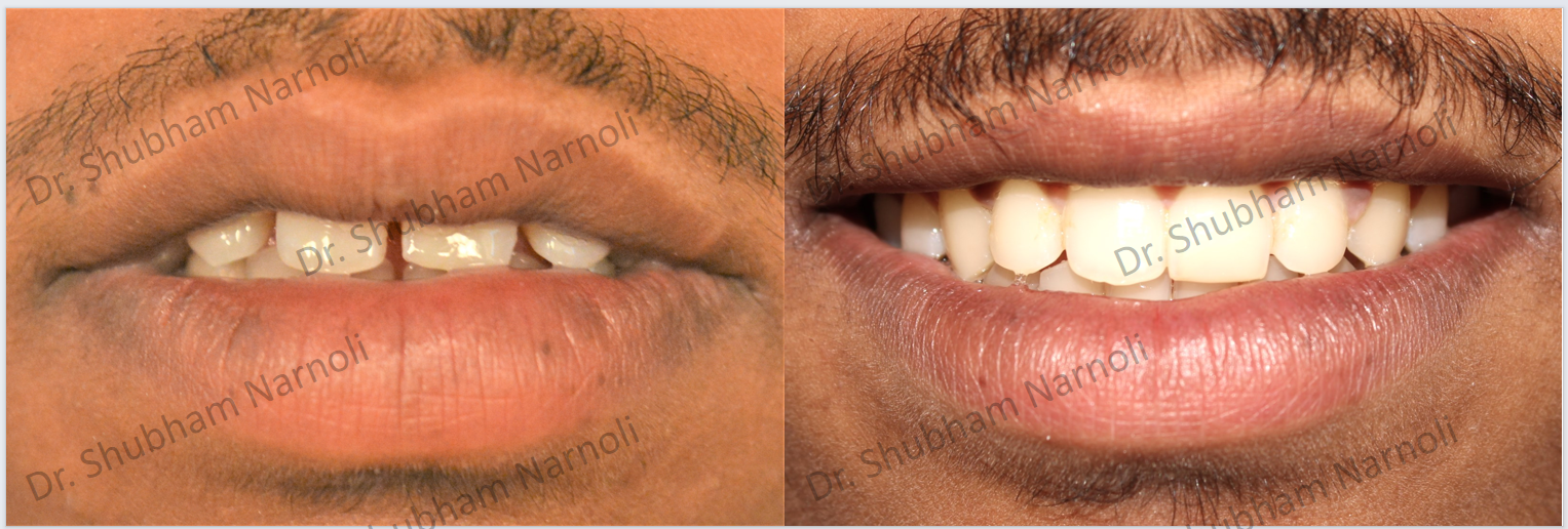 Before and after dental transformation 7