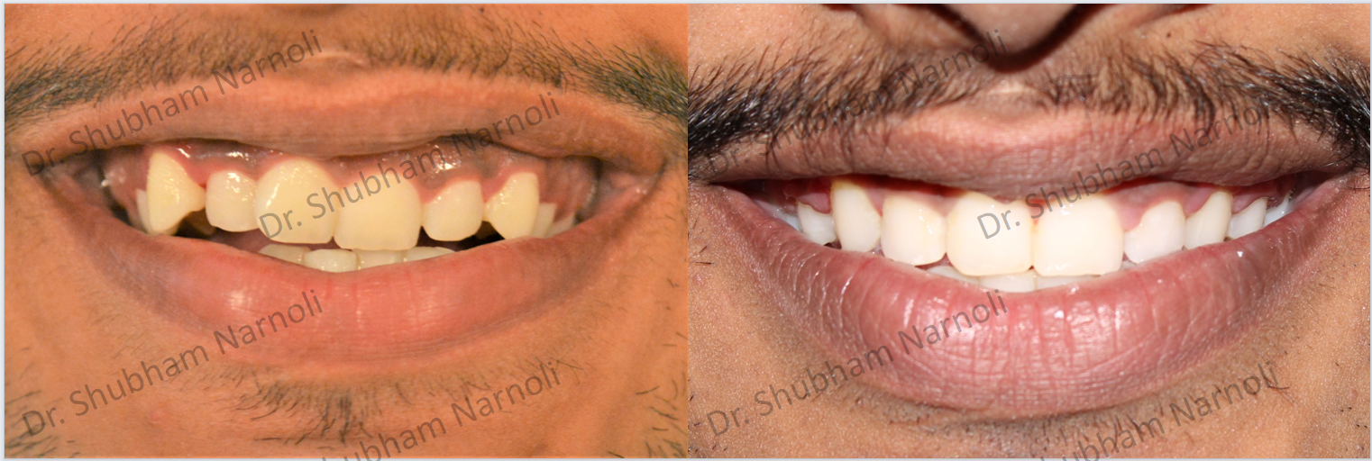 Before and after dental transformation 9