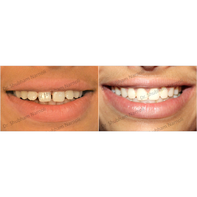 Smile makeover