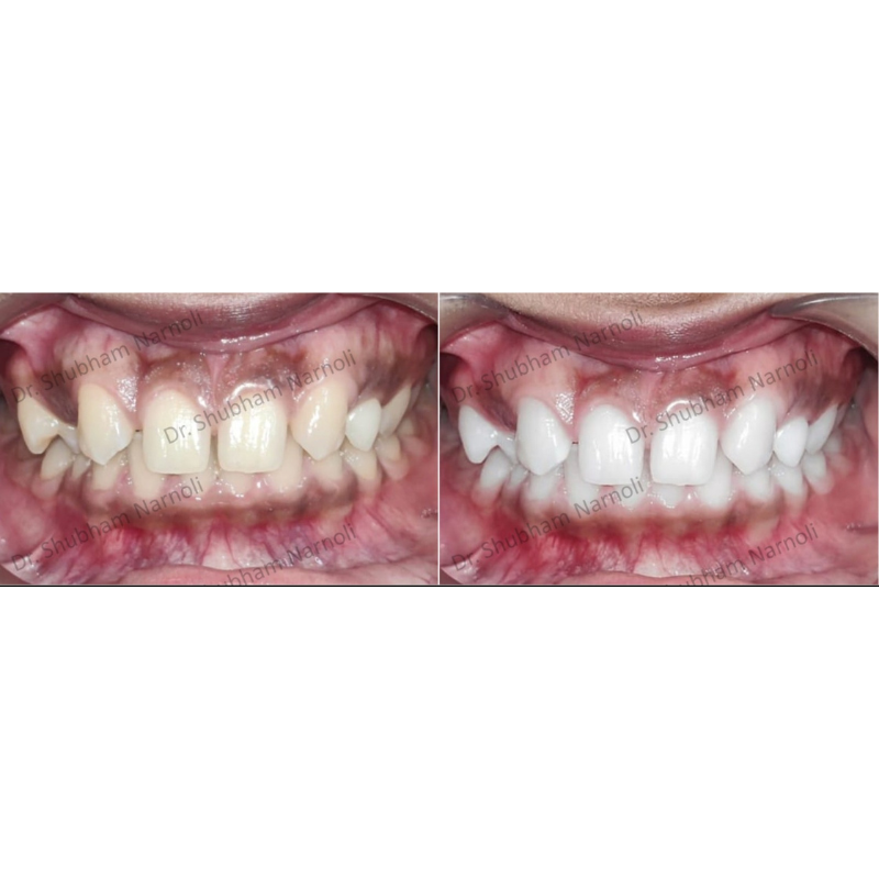 Teeth whitening